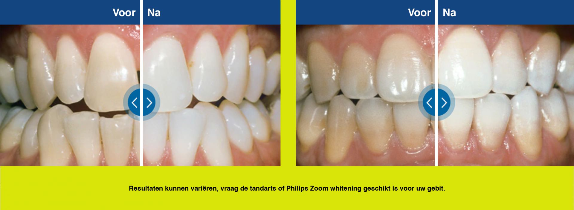 Veilig tanden bleken bij Tandartsenpraktijk Ivoren Toren Hilversum met Philips Zoom
